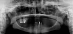 BOI implant