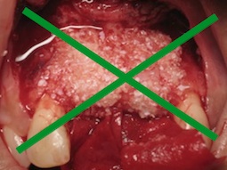 no-bone-graft